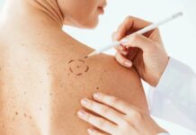 “Salva Tu Piel”: La Roche-Posay realizará chequeos gratuitos de lunares en Playa Reñaca